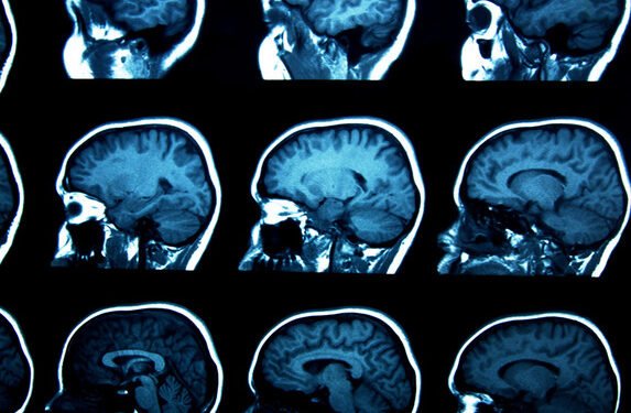 Un estudio arrojó resultados esperanzadores sobre un nuevo tratamiento contra el Alzheimer