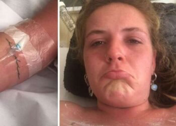 Una mujer fue a la cama solar y terminó con el 90% del cuerpo quemado: “Es insoportable el dolor, me quemé hasta los párpados”