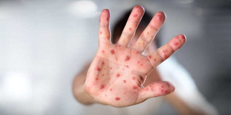 El Ministerio de Salud confirmó el primer caso sospechoso de viruela del mono