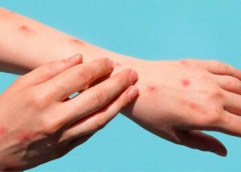 Sexto caso de viruela del mono confirmado en el país