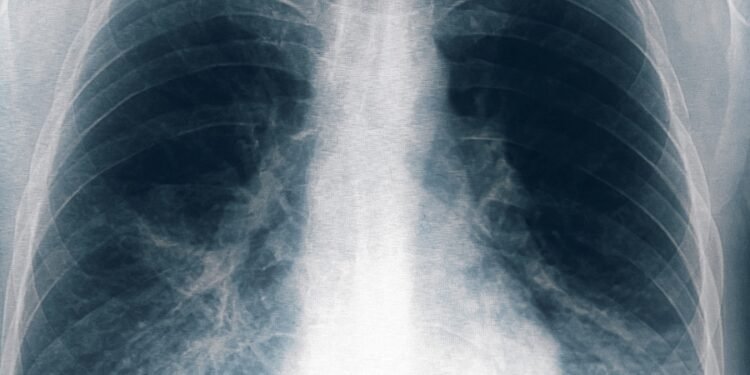 Ocho nuevos casos de neumonía bilateral por Legionella se registraron en Tucumán