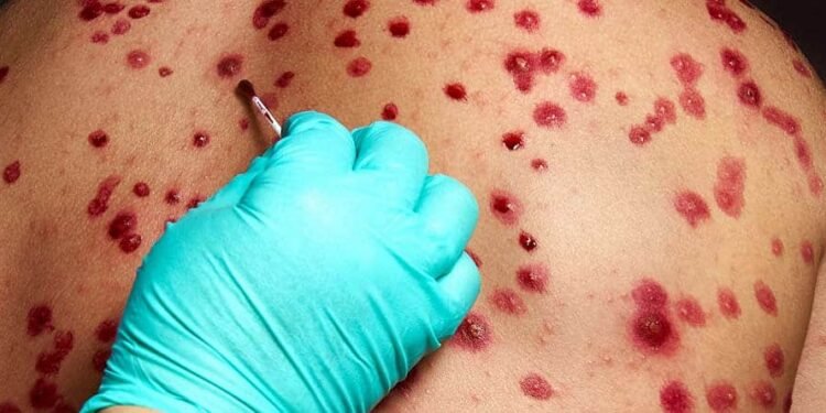 Salud registró un caso sospechoso de viruela del mono en San Juan
